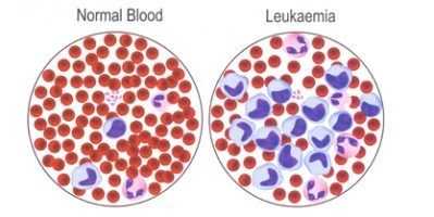 Nutrition for Cancer
