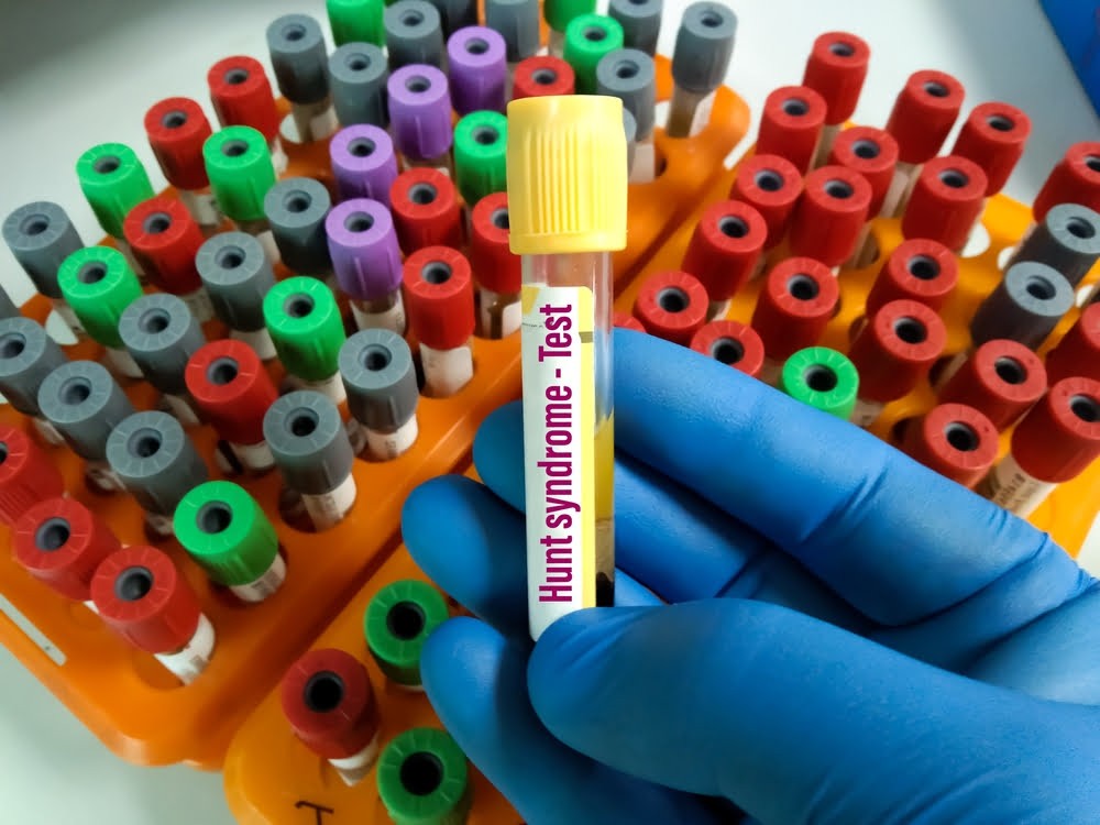 متلازمة رامزي هانت العلاج الطبيعي: رأي الخبراء