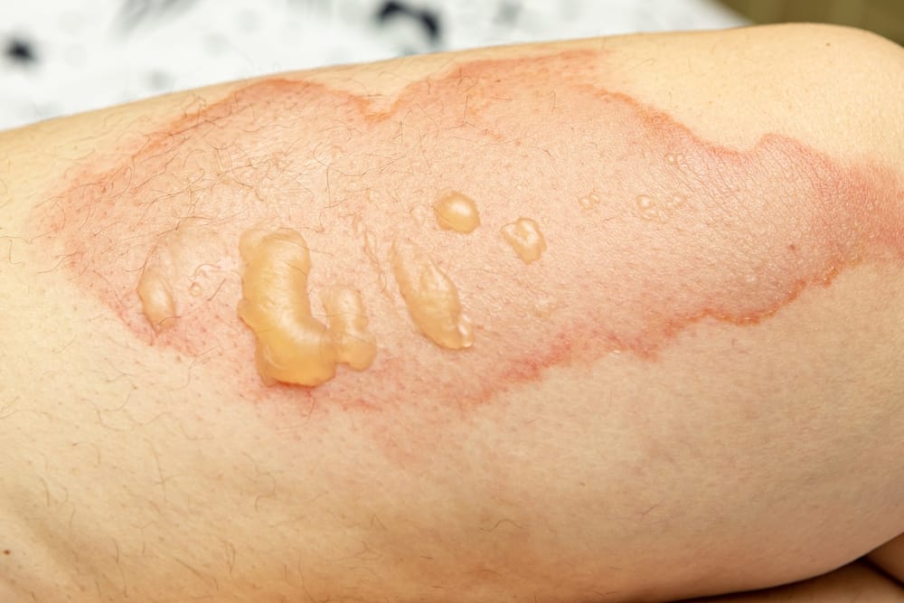 حرق العشب: الأسباب والأعراض والعلاج والوقاية وكيفية العلاج في المنزل