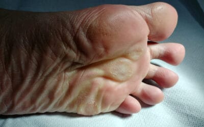 What is the Difference Between Corn and Wart: A Common Skin Condition